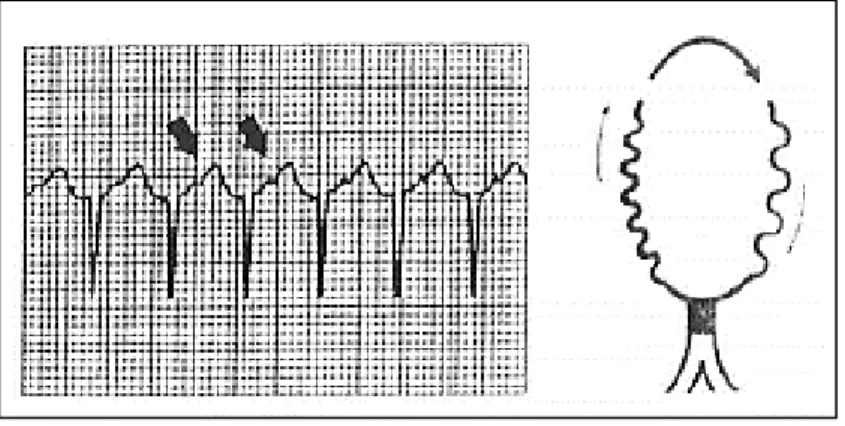 Figure  14  :  électrocardiogramme  d’une  TRIN  de  forme  slow/slow.  Les  flèches  montrent  des  ondes  P  rétrogrades  équidistantes  du  qRS  précédent et suivant