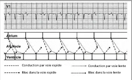 Figure 15 : électrocardiogramme montrant une double réponse ventriculaire. 