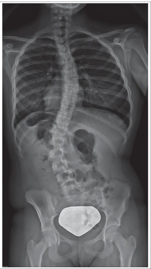 Figure 0.1 Radiographie postéroantérieure montrant une scoliose