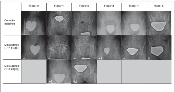 Figure 2.5 Sample radiographic images correctly classiﬁed by automatic grading method (top) and misclassiﬁed by one grade