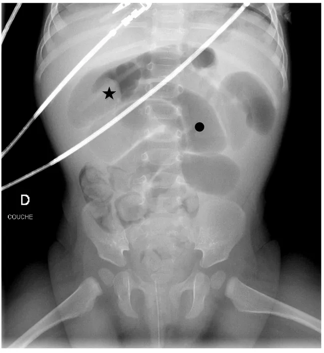 Figure 2 : ASP : syndrome occlusif  