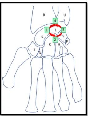 Figure 8 : Progression lésionnelle en 4 stades selon Mayfield 