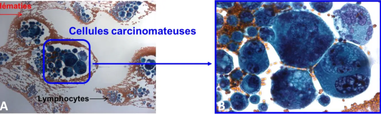 Figure 3. Liquide Pleural : cellules métastatiques d’Adénocarcinome bronchique.  