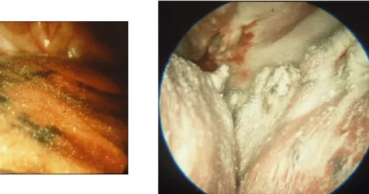 Figure 5. Talc Poudrage : instillation de talc dans la cavité pleurale sous contrôle de la  vue permettant une répartition diffuse et uniforme du talc (particules blanches)