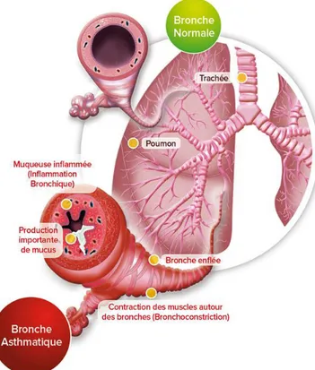Figure 1. Structures d'une bronche saine (haut) et d'une bronche d'asthmatique en crise (bas)