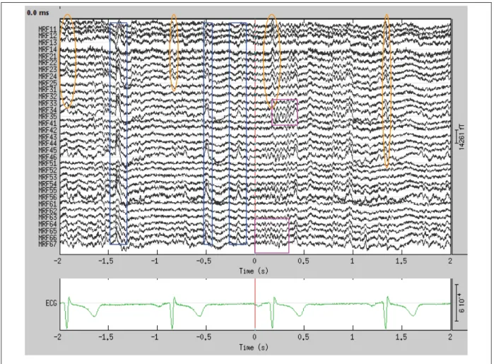 Figure 1.2 Mesures MEG des capteurs du lobe frontal droit (MRF :Meg Frontal Right) et le signal ECG du patient (données du sujet PA65)