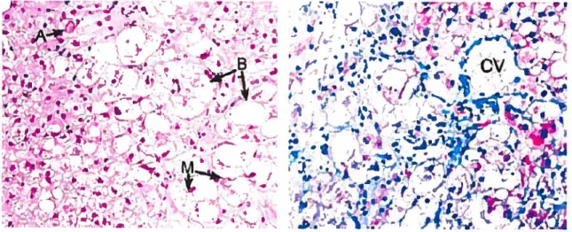 Figure 2: Caractéristiques histologiques de la stéatohépatite non alcoolique: Présence de stéatose micro et macro-vésiculaire, de corps de Mallory (M) d’hépatocytes ballonnés (B) et apoptotiques (A), dénotant des lésions cellulaires, ainsi que de la fibros