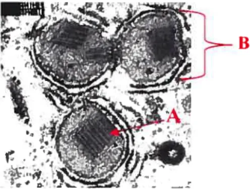 Figure 5: Photographie en microscopie électronique des inclusions para-cristallines (Flèche A) à l’intérieur des méga-mitochondries hépatiques (lettre B) chez un patient souffrant du NASH.