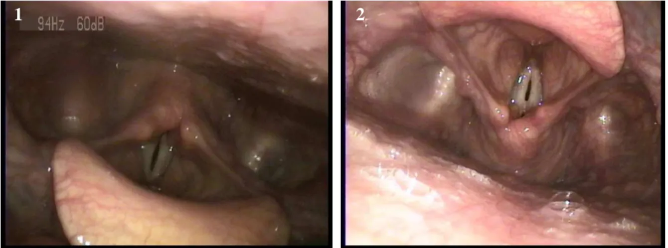 Figure 10 : Vues prises en fibroscopie souple :  1) vue classique supérieure, 2) vue postérosupérieure haute