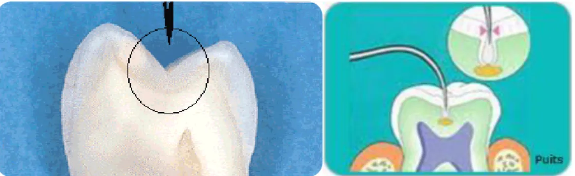 Figure 4 :Dent avec sillons sans fissure(13)Figure 5 : Dent avec fissures et puits 