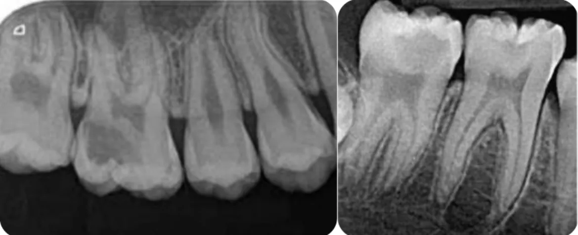 Figure 16 : Caries cachées PMP mandibulaires et maxillaires (25,44) 