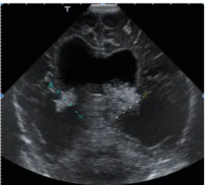Figure 5 : ETF du cas n°1 à la naissance. Lésions hyperéchogènes bilatérales dans les ventricules  avec dilatation