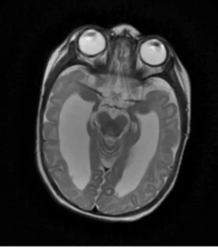 Figure  6 :  IRM  cérébrale  du  cas  n°2  à  deux  mois.  Coupe  axiale,  séquence  T2,  retrouvant  une  dilatation ventriculaire et des hyposignaux témoignant d’une hémorragie
