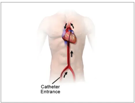 Figure 1.1 Percutaneous catheter-based intervention : the catheter (the black tube) is inserted from a blood vessel in the