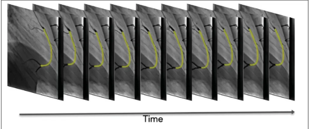 Figure 4.1 Overview of the segmentation of a coronary artery in 2D+time: Segmenting and tracking the RCA lumen (highlighted