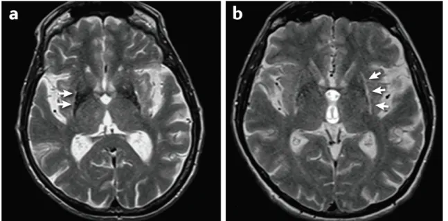 Figure 5 : Éléments communément retrouvés sur une IRM cérébrale standard chez les  patients avec AMS 