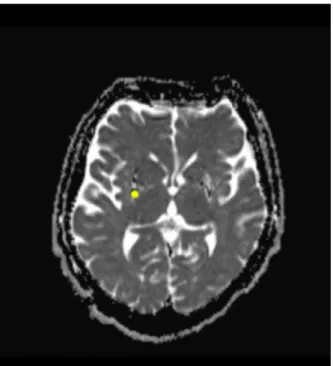 Figure 6 : IRM en séquence ADC DWI chez un patient avec AMS – P 