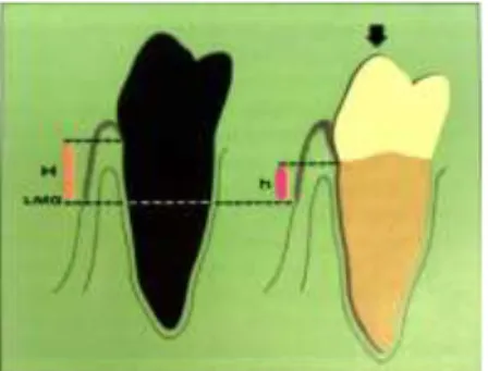 Figure 18 : Réduction de hauteur de la gencive attachée lors de l’ingression 