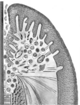 Figure 4 : La lésion avancée 