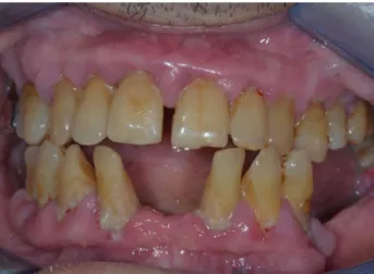 Figure 6 : Cliché intra-oral d’un patient diabétique non équilibré atteint d’une parodontite 