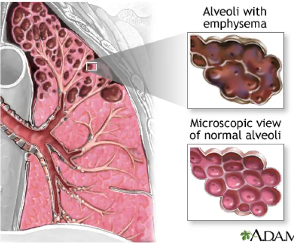Figure  1 : Représentation des différences entre un poumon en santé (coin  inférieur   droit)   et   celui   d'une   personne   souffrant   d'emphysème   (coin  supérieur droit)