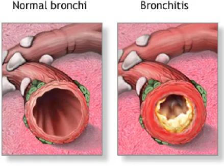 Figure 2 : Représentation des différences entre les bronches d'une personne  en   bonne   santé   (gauche)   et   ceux   d'une   personne   souffrant   de   bronchite  chronique   (droite)