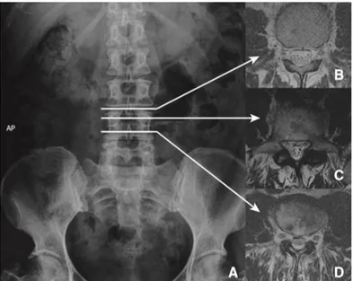 Figure 7 : anatomie du canal rachidien en imagerie par résonance magnétique (IRM) : A) Radio- Radio-graphie du rachis lombaire de face, B) canal central, C) Canal latéral, D) Canal de conjugaison  D’après Ferrero H, traitement chirurgical des sténose lomba