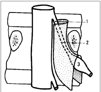Figure 8 : Parcours d’une racine lombaire au sein du canal latéral et du foramen de conjugai- conjugai-son : 1) défilé disco articulaire, 2) Récessus latéral, 3) Foramen de conjugaiconjugai-son  
