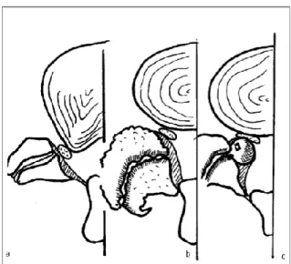 Figure 9 :   Les rétrécissements du défilé disco articulaire : a) protrusion discale, b) Hypertro- Hypertro-phie du massif articulaire postérieur, c) kyste articulaire postérieur 
