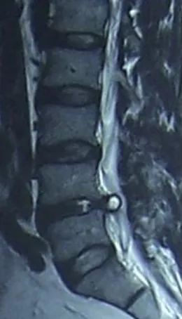 Figure 11 : IRM en coupe sagittale : Kyste articulaire postérieur L4-L5, dont la paroi apparaît en  hyposignal T2 et le contenu liquidien en hypersignal T2  