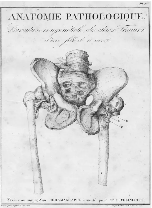 Figure  2:  Planche  anatomique  d’un  bassin  de  face  avec  une  luxation  congénitale  de  hanche  bilatérale, publiée dans  Essai et Observations sur la manière de réduire les luxations spontanées  ou symptomatiques de l’articulation ilio-fémorale, to