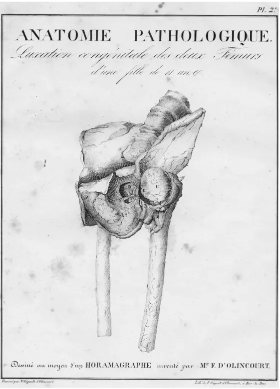 Figure  3:  Planche  anatomique  d’un  bassin  de  profil  avec  une  luxation  congénitale  de  hanche  bilatérale,  publiée  dans  Essai et Observations sur la manière de réduire les luxations spontanées  ou symptomatiques de l’articulation ilio-fémorale