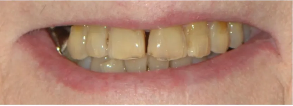 Figure 1.5 : Sourire d’une patiente de 75 ans.  