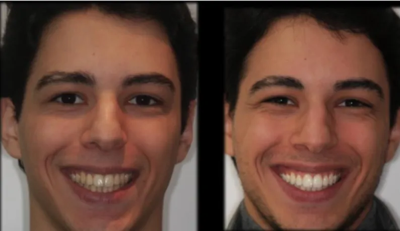Figure 2.2 : Exemple d’un traitement d’un mois chez un patient de 18 ans.  