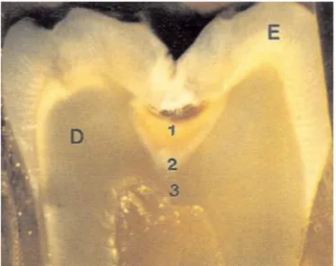 Figure 4 : Les couches de la dentine cariée 