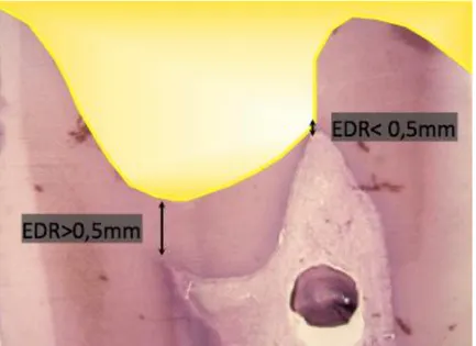 Figure 9 : Représentation de l’épaisseur de dentine résiduelle (EDR) 