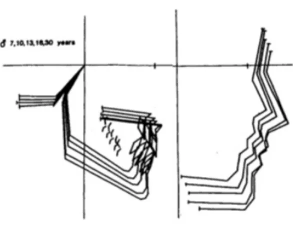 Figure 1.  Superposition de tracés d'un garçon ayant une occlusion normale aux âges  de 7, 10, 13, 16 et 30 ans, démontrant la modification dans la forme et la taille de la face  durant la croissance