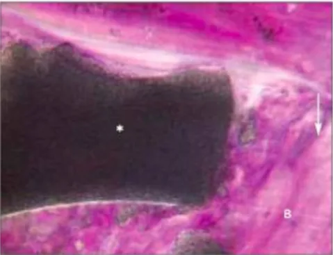 Figure 5 : Formation osseuse autour de la particule de biomatériau 