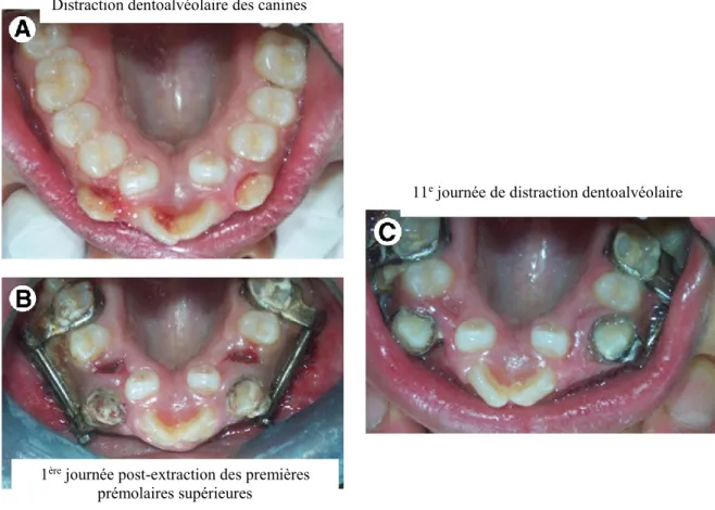 Figure 9 : Exemple clinique d’une distraction dentoalvéolaire  (Images adaptées de Kisnisci et Iseri) (47) 