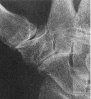 Figure 9 - Grade 3 de Crosby  Érosion, sclérose et irrégularités  Conflit médial (effet came) 