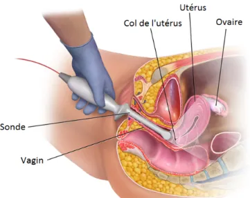 Figure 2. Technique de mesure du col utérin par échographie transvaginale 