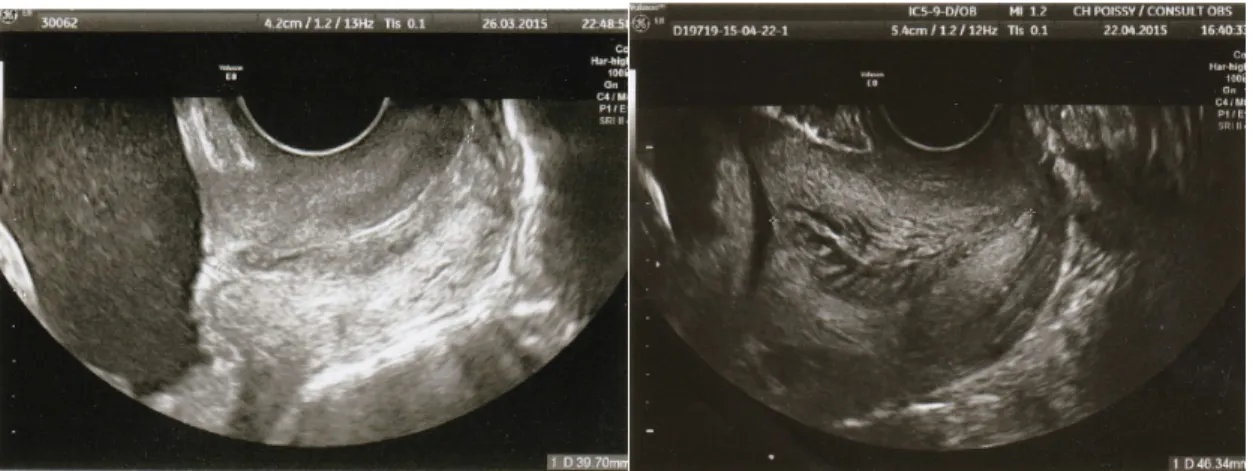 Figure 3. Mesure échographique du col utérin par voie transvaginale : col normal. 