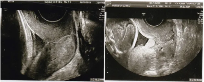 Figure 4. Mesure échographique du col utérin par voie transvaginale : col raccourci. 