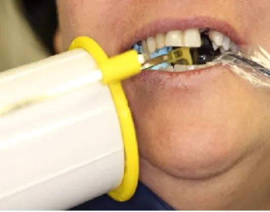 Figure 1: Individualized silicon bite block and x-ray positioning technique 