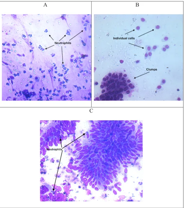 Figure  3.  Endometrial  cytology  slides.  Picture  A  shows  a  large  quantity  of  neutrophils