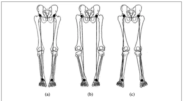 Figure 1.13   Illustration de trois types de désalignement autour du genou dans   le plan frontal et de leur effet sur les os des membres inférieurs