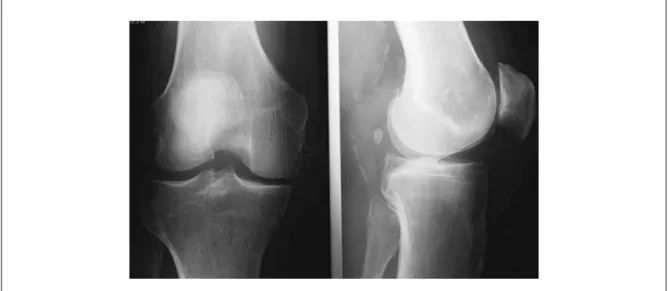 Figure 1.14   Deux images radiologiques du genou. À gauche, la radiographie montre le  compartiment fémoro-tibial en bonne santé, tandis que la radiographie de droite  