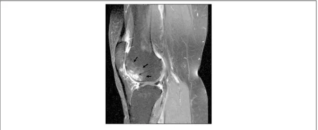 Figure 1.15   Imagerie par résonance magnétique du genou d’un patient gonarthosique  montrant les différentes lésions, source de douleurs