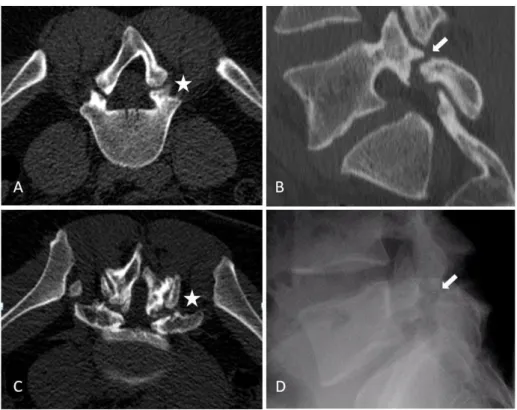 Figure 7 : Arthrite septique articulaire postérieure.  Coupes axiale (A) et coronale  (B)  T2  STIR