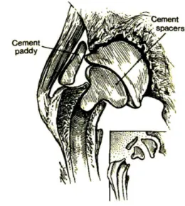 Figure 6 : Espaceur et ciment intra-articulaires 